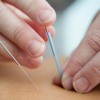 Acupuncture needles being placed on a person