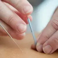 Acupuncture needles being placed on a person